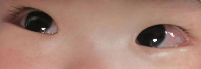 儿童持续发热不退 当心这个病