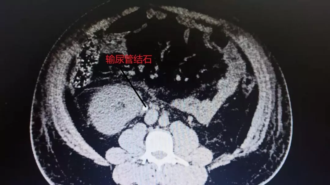 陝中二附院軟鏡雖軟能克頑石探秘輸尿管軟鏡鈥激光碎石術