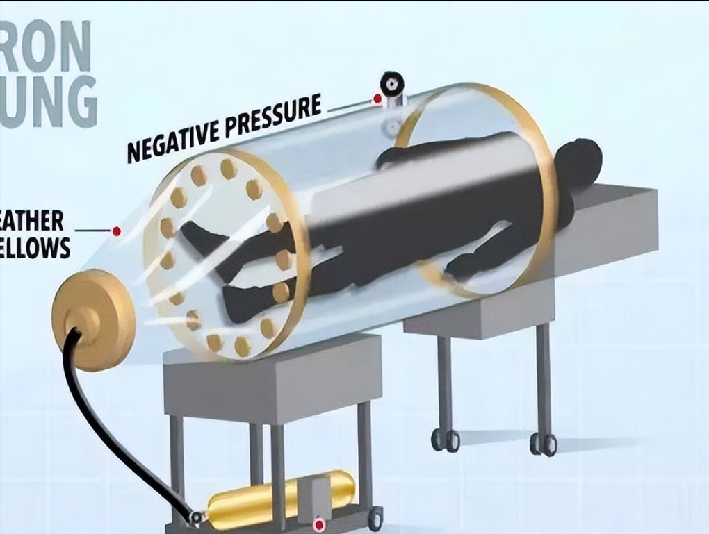 回顾被困铁桶69年的铁肺人一生无法呼吸停电就意味着死亡