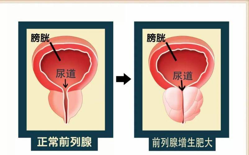 前列腺炎反复发作?有什么症状和危害?贡方堂中医肿瘤科教你预防