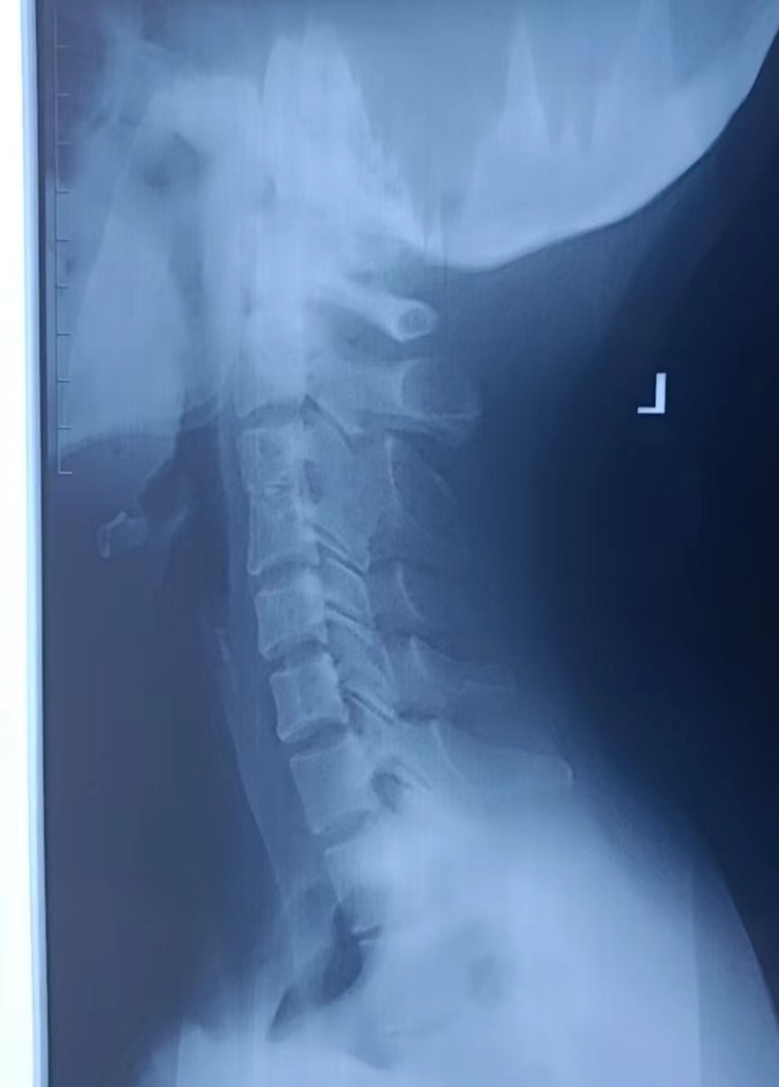 甘草學園|c3/4椎體融合 頸椎左凸 寰樞椎錯位頸椎病案