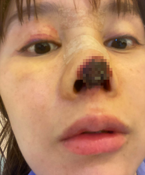 女星高溜整容失败遭毁容,鼻头坏死触目惊心,维权无果欲跳楼自杀