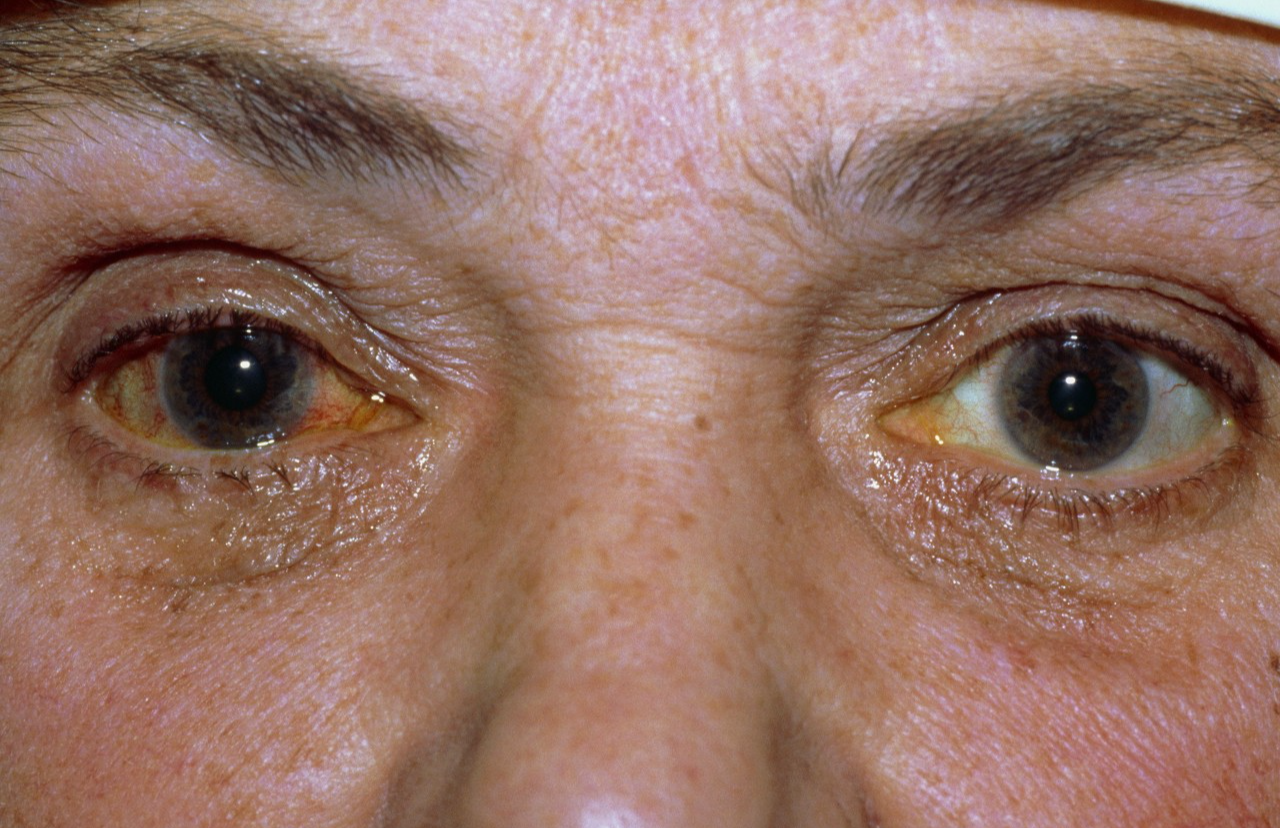 临床上危重患者通常眼睑闭合不良,使用保护性眨眼反射的能力降低