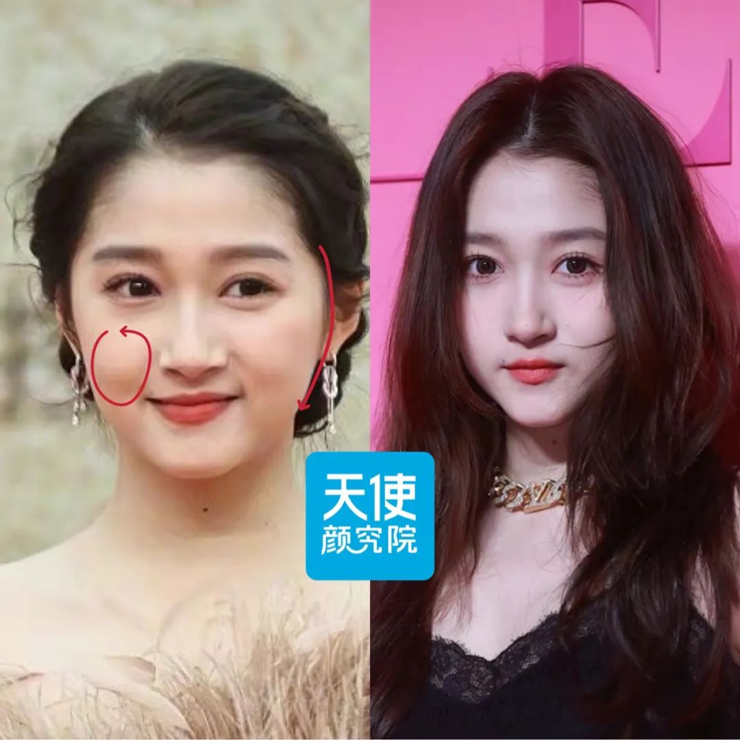 关晓彤是不是do脸了?凹脸变得幼态又平整!