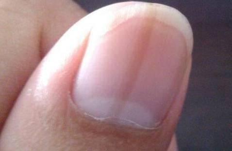 指甲表面有明显的竖纹,是表示健康,还是预示身体出什么问题了?