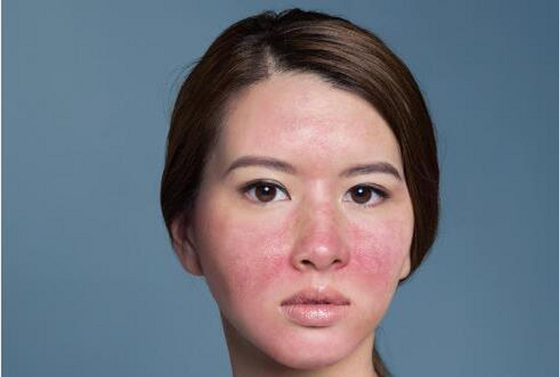 脸上的红血丝怎么去除有什么办法 #医美科普挑战赛#   为了减少红血丝