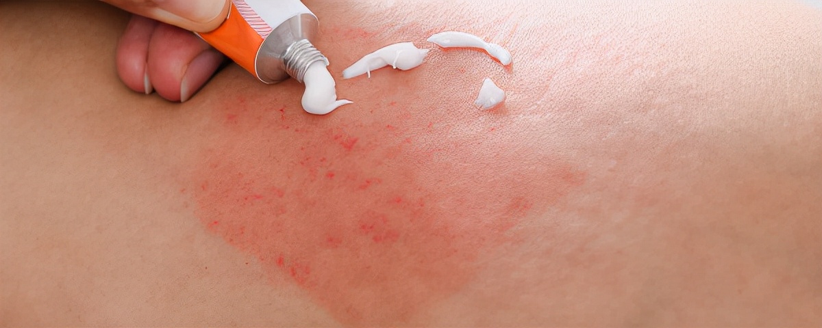 身上发痒一挠就红一片 可能是这5种情况导致的