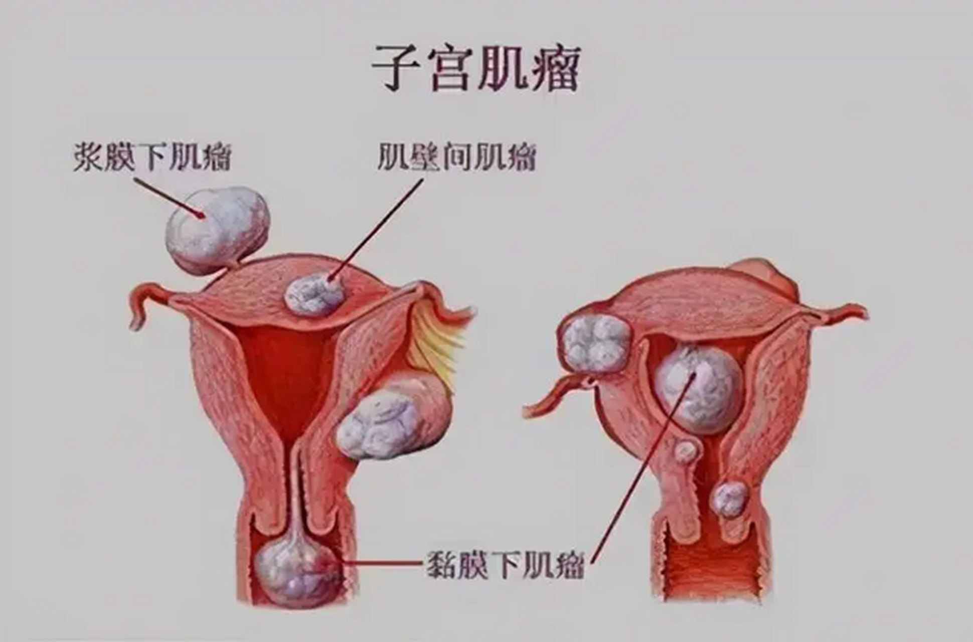 前壁肌壁间子宫肌瘤图图片