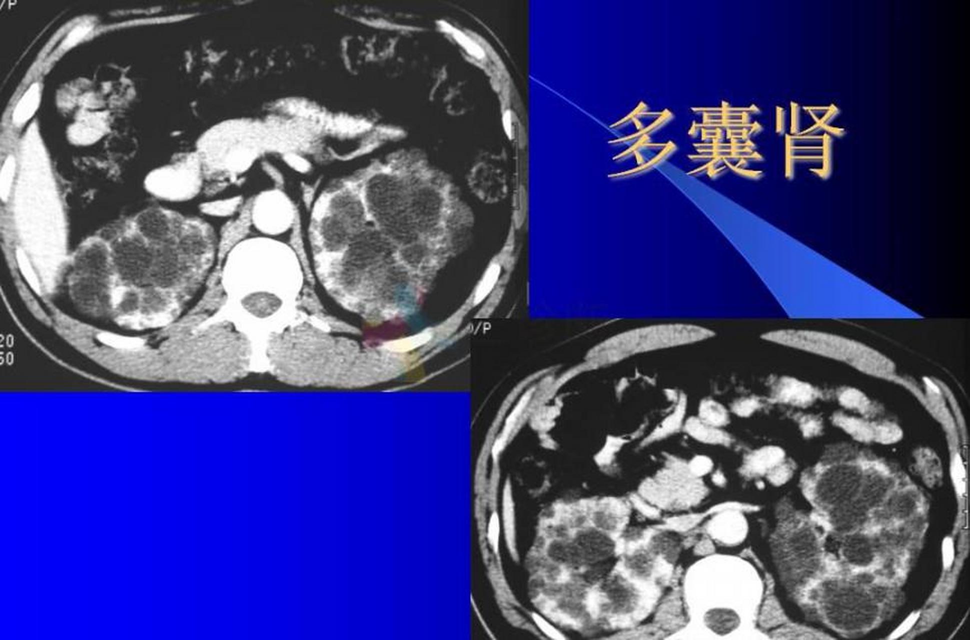 多囊肾会随着年龄的增长,囊肿逐渐增大,对人们的健康构成了很大的危害