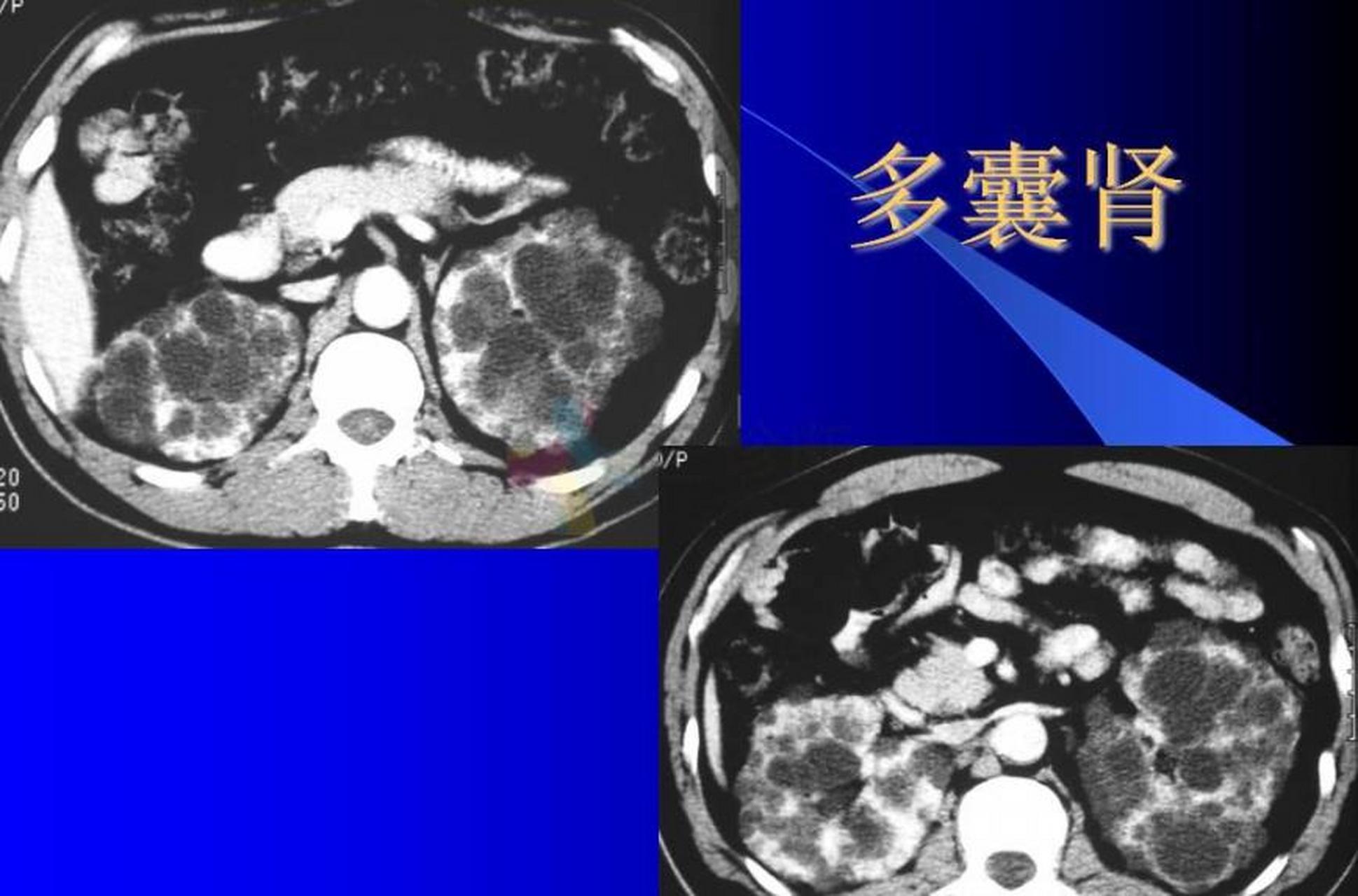 多囊肾和正常肾的图片图片