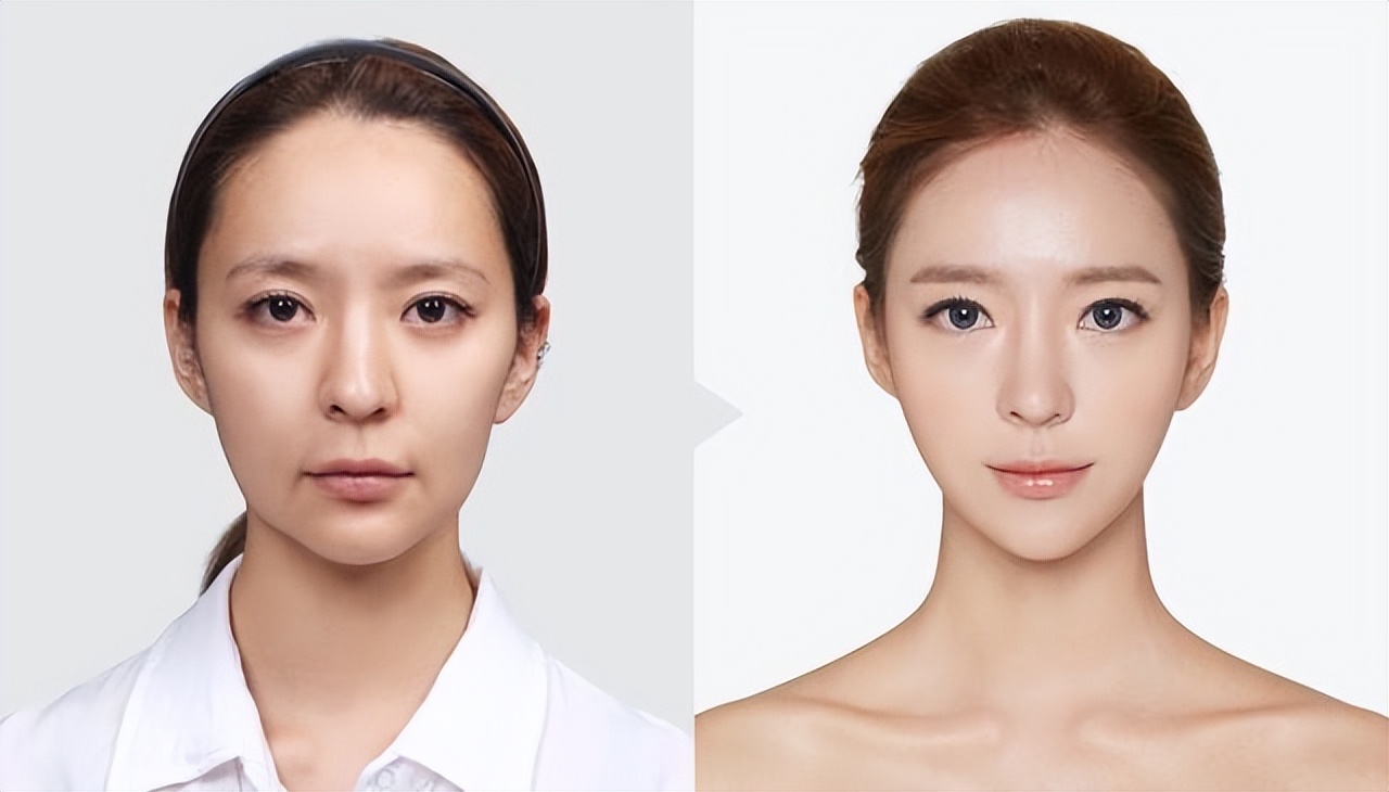 为何"悬胆鼻"被称为鼻中之王?隆鼻的方法又有几种?