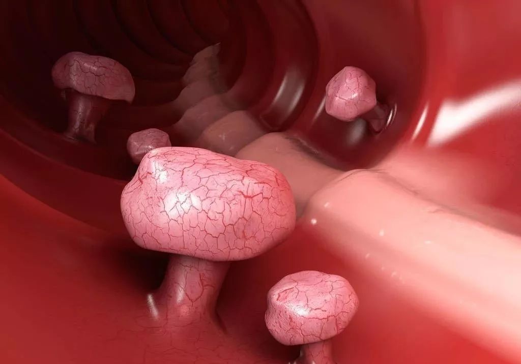 子宫息肉,常见症状是异常子宫出血,发病部位在子宫,不具传染性