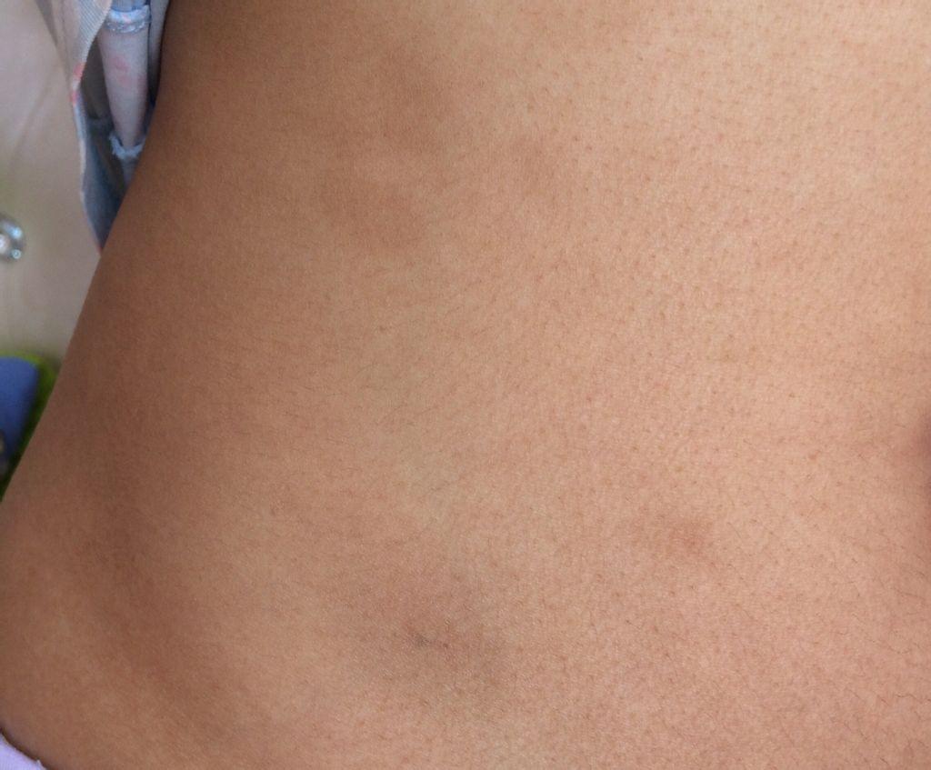 肾上腺皮质功能减退症女性患者较多,有活动性结核者,应抗痨治疗