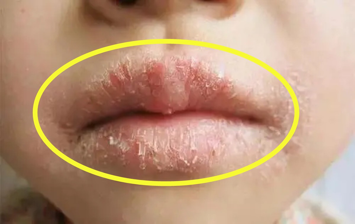 川崎病嘴唇干裂图片图片