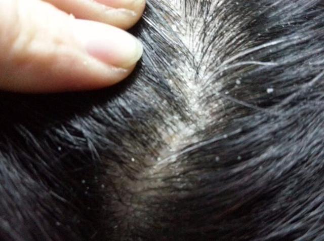 头发爱出油,还容易抠出很多白泥?可能不是头皮屑,千万别搞错了