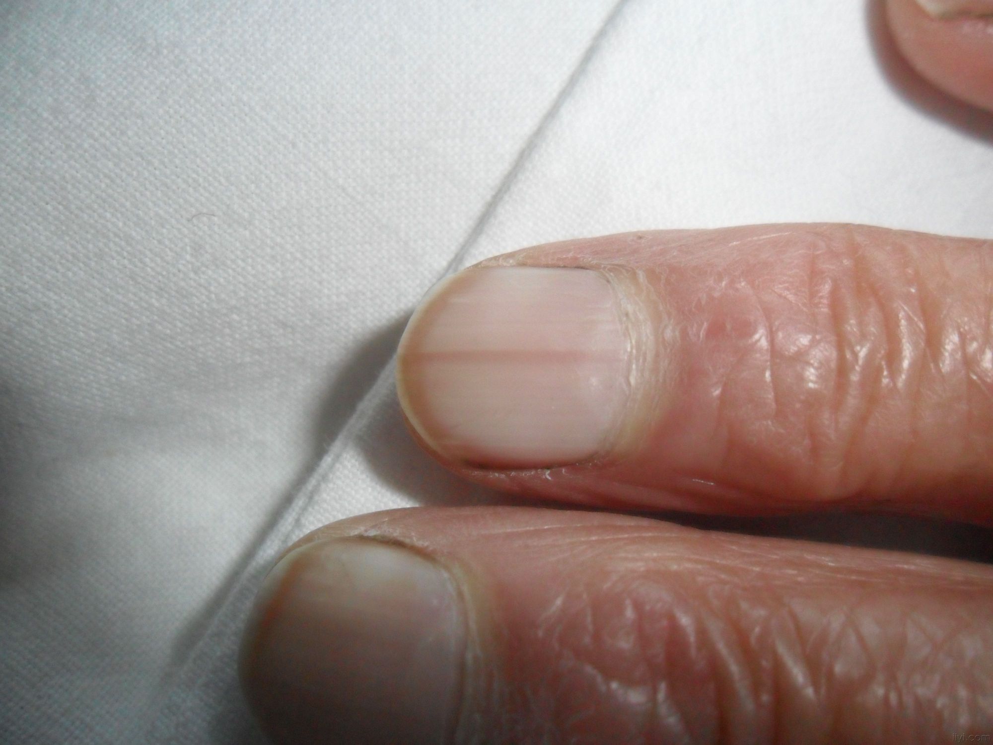 甲母痣患者建议及时就医,怀疑有恶变的,及时进行手术治疗