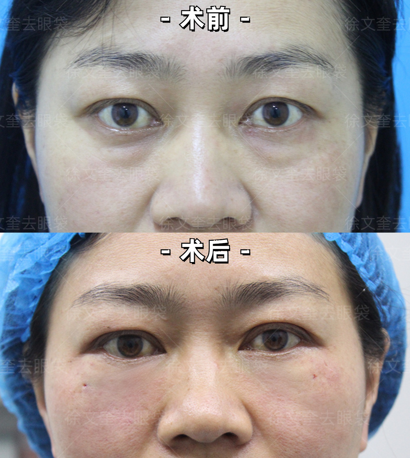 眼袋手术案例:41岁女性泪沟型眼袋不开刀不留痕治疗效果