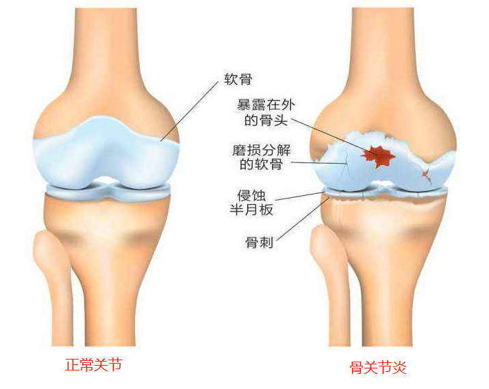 膝关节为什么疼痛?能治好吗?该如何应对呢?给您详细讲清楚