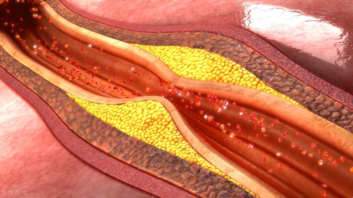 主动脉硬化怎样治疗 软化血管最重要