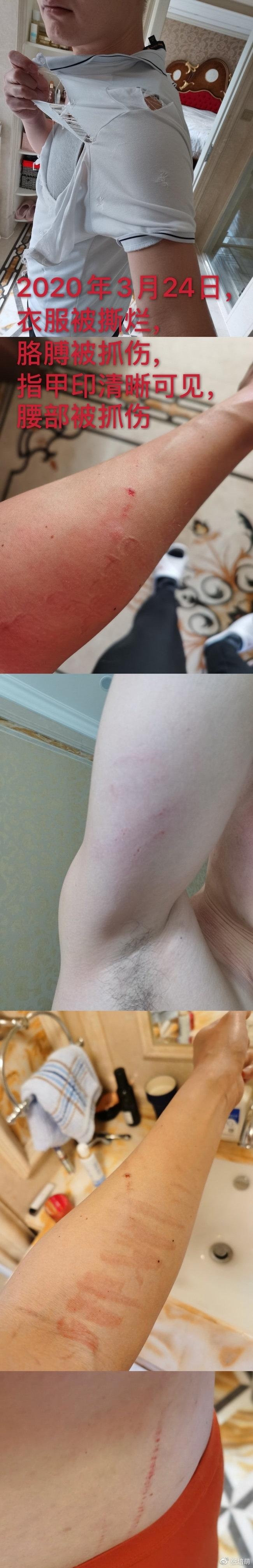 短跑名将张培萌回应家暴,称多次被打伤追砍,晒"睾丸外伤"证据