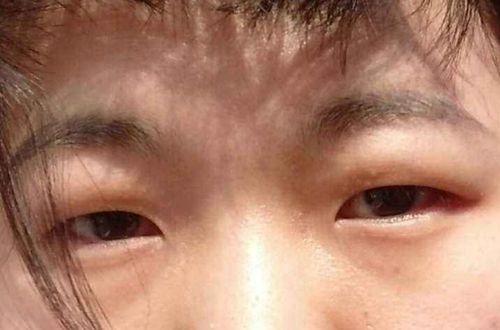 后天肿眼泡,眼睛无神还臃肿?教你几招,不用手术或可轻松消除