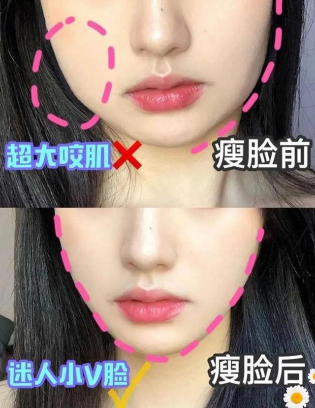 瘦脸针的优点有哪些?注射后需要留意什么?