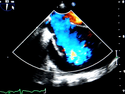 技术导航|心脏超声检查新视窗——经食管超声心动图检查