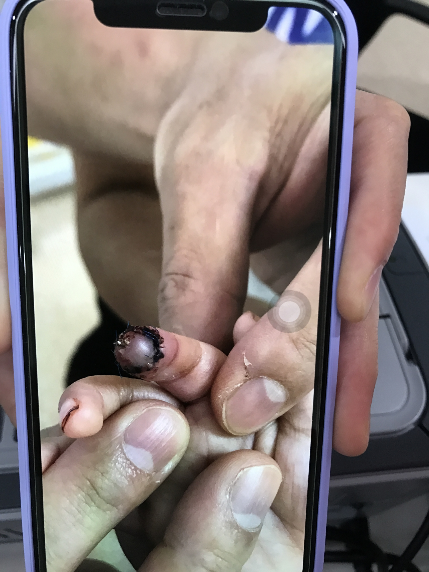 11个月大女婴拆石膏时一截手指被医生剪断,家长:断指已再植,医院:深感