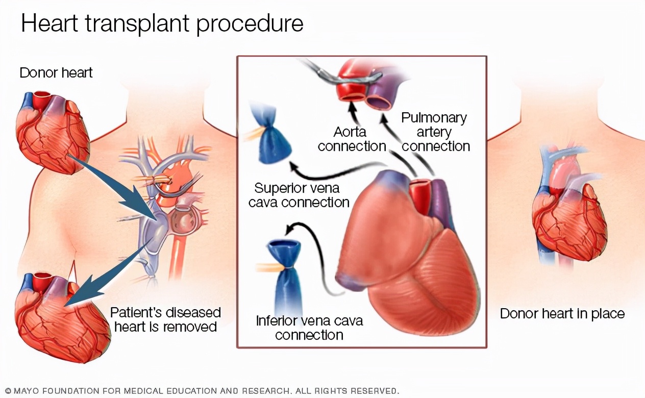 "猪心人"存活俩月去世:究竟是何原因?心脏移植后性格会大变?