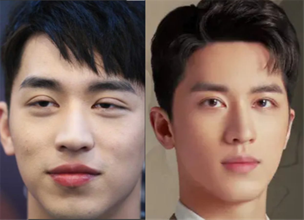 取假体,紧致皮肤,修复双眼皮,明星整容失败想要回春得多努力?