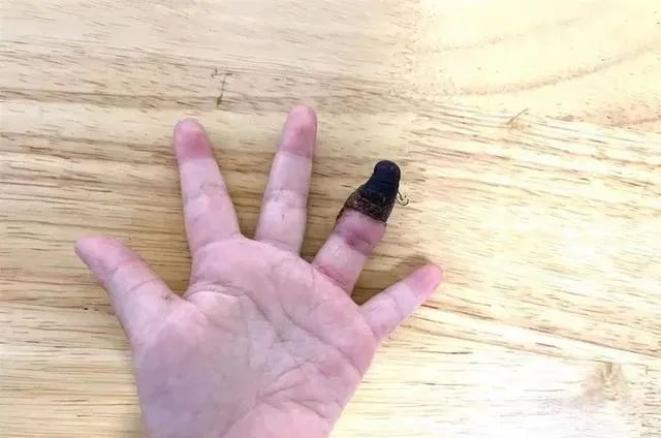 12355自护学堂 | 错误包扎致女童手指坏死!这个错误一定要小心!