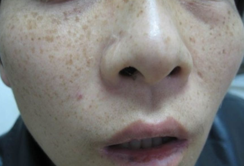 每天喝牛奶可以淡斑吗?医生:真正美白的有2种食物,不妨常吃