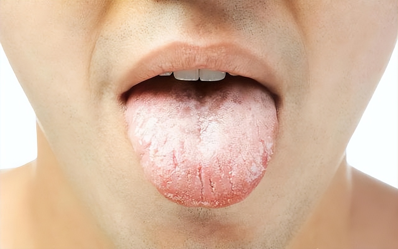 这样的齿痕舌:不仅仅提示气虚,湿气重,也提示脾胃虚弱!