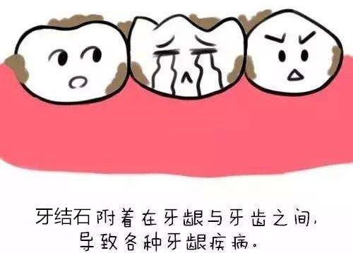 牙结石怎么去除干净?牙结石不要放任不管,危害很大!