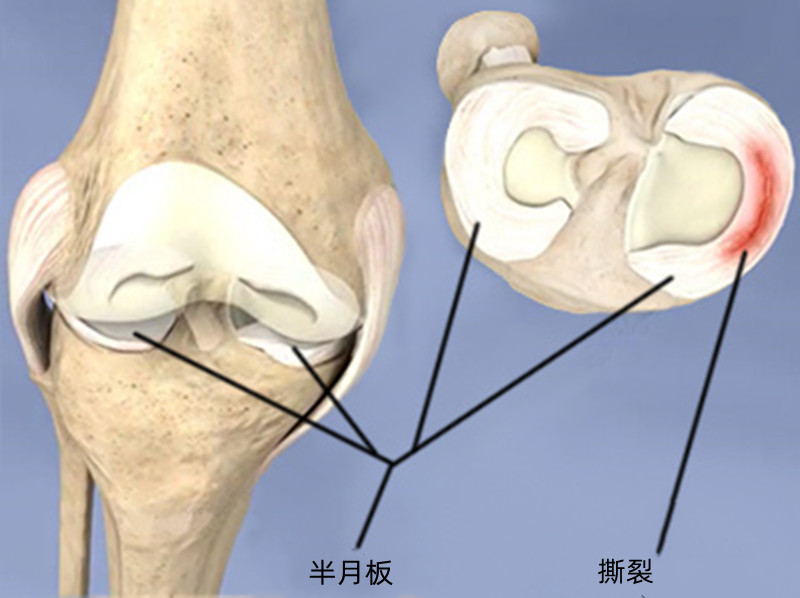 膝蓋旁邊長了一個包,是不是半月板囊腫,嚴重嗎?