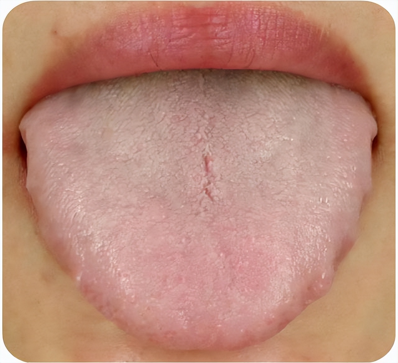 这样的齿痕舌:不仅仅提示气虚,湿气重,也提示脾胃虚弱!