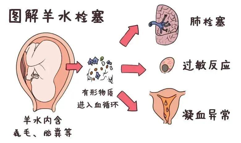 羊水栓塞是怎么回事?