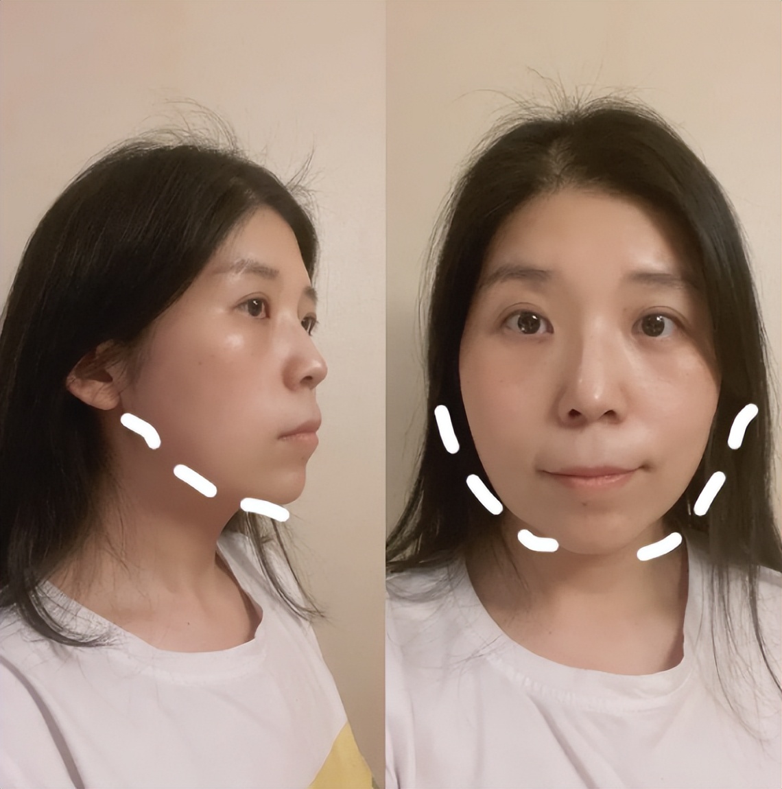 颈阔肌的提升,对于面部的改善有帮助,效果很明显