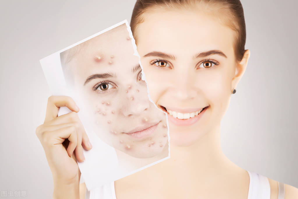 puhaha丨痘痘,拜拜了您嘞