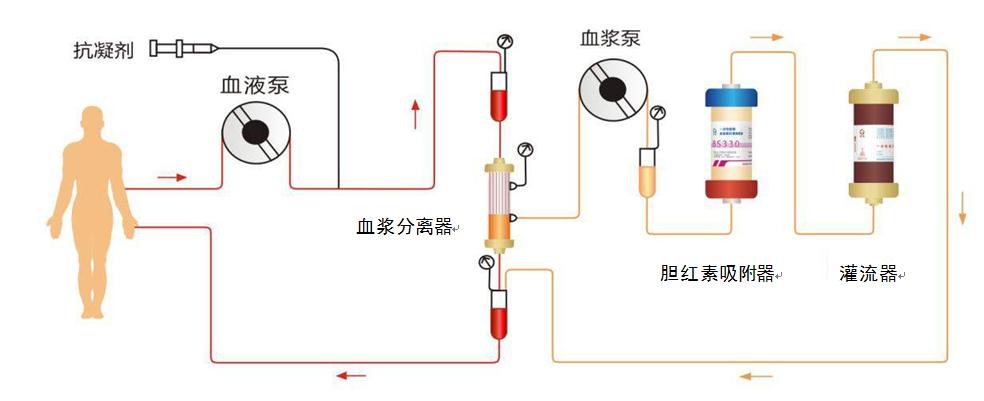 血液净化示意图图片