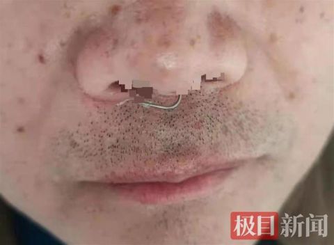 鱼儿脱钩,鱼钩一弹钩住钓鱼男子鼻腔