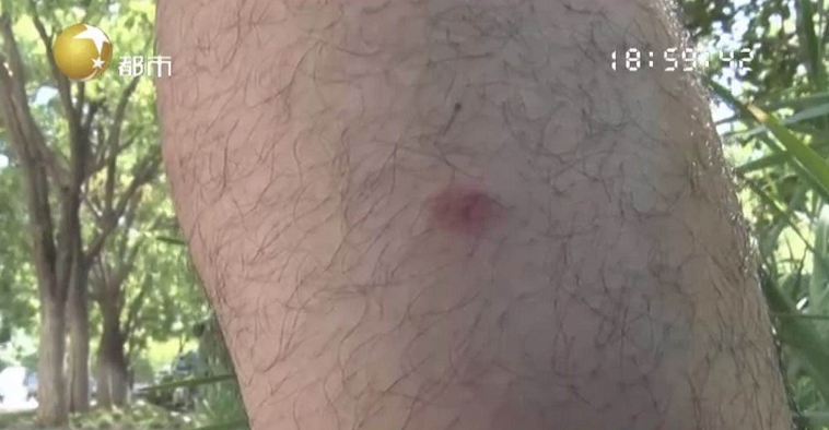 热点|男子被蚊子咬了一口,竟连做3次手术保命!这个动作可不能再做了