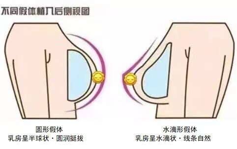 胸型可以选择吗?