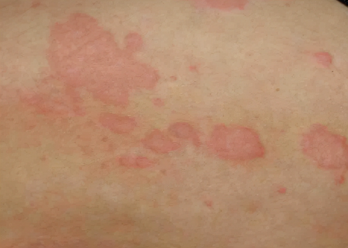 多形性红斑是一种急性炎症性皮肤病,常伴有粘膜损伤,易复发