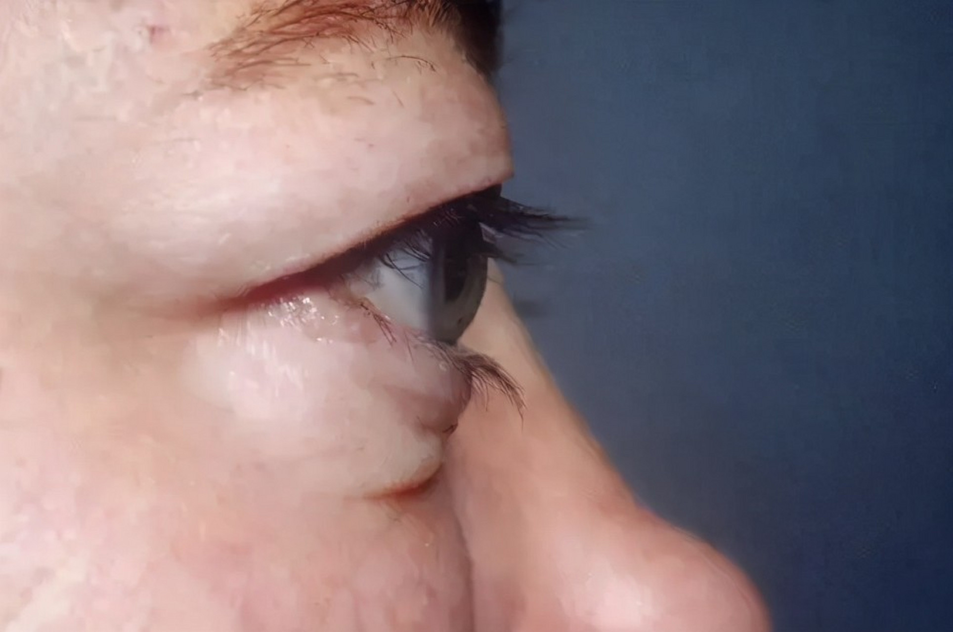 部分甲亢患者的血液中可产生一种导致突眼的物质,这种物质可使眼球后