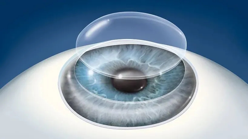 圆锥角膜病症多在青春期前后发病,和遗传因素有一定的关系