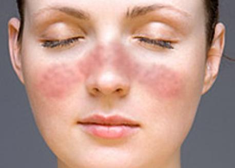 系统性红斑狼疮无法治愈,想要缓解症状需长期用药,进行维持治疗