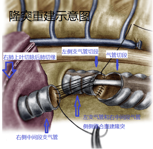 气管隆突成形术图片