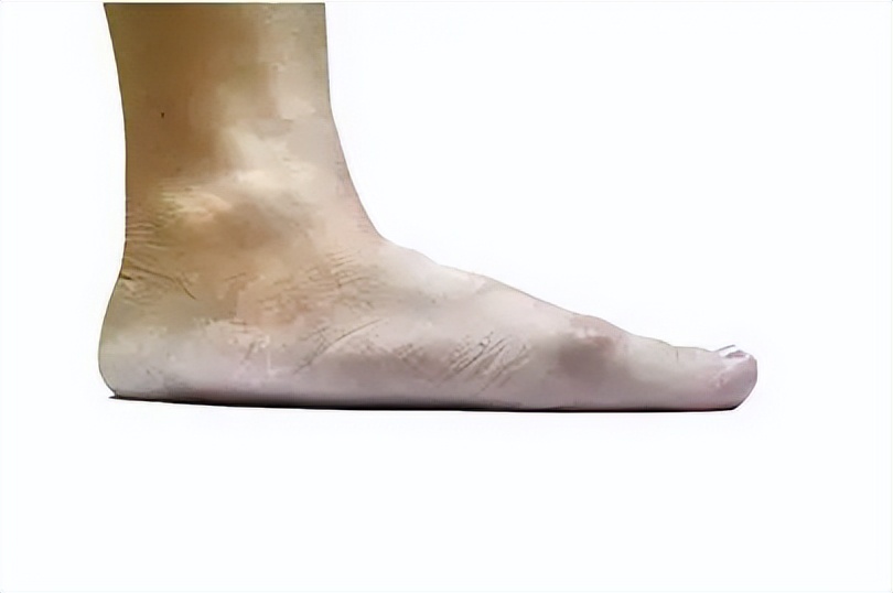 「科普」脚底平一点是正常的吗?教你如何快速判断扁平足