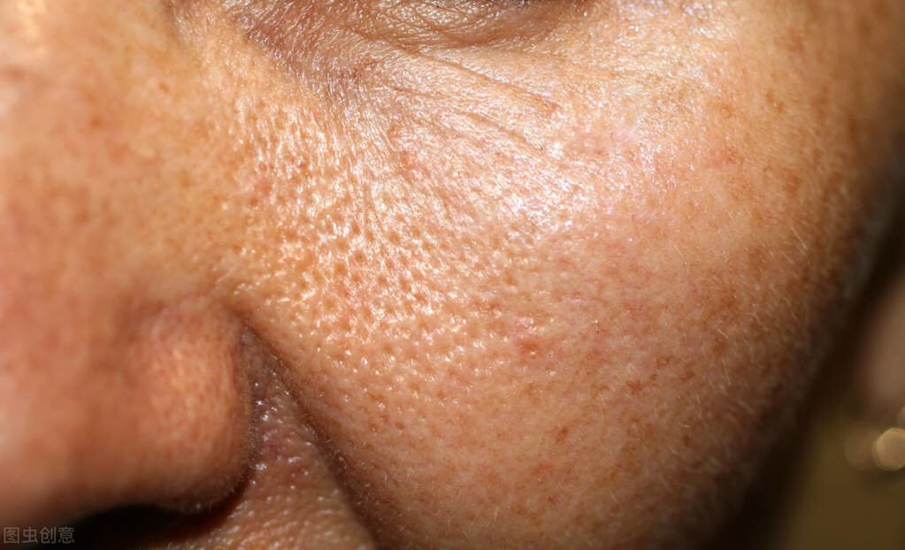脸上出现这3个特征,螨虫已经滋生,不想毁容就把除螨提上日程